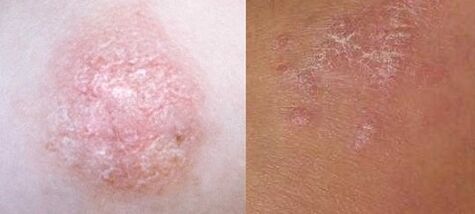 Psoriasis in the initial stage